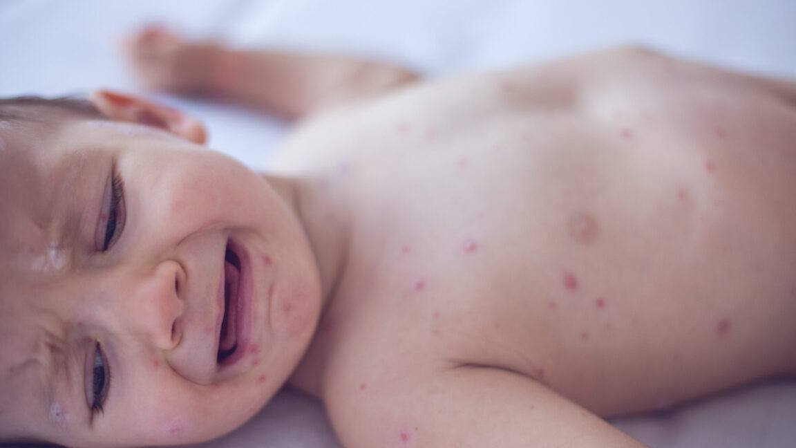 Pennsylvania'da On Yıllardır Görülmemiş Congenital Kızamık Uyarısı